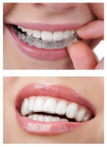 Invisalign Orthodontie à Laval